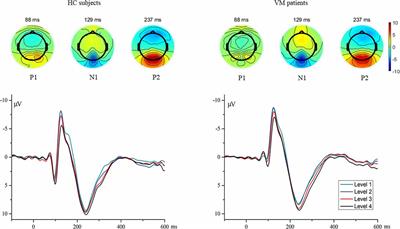 Altered Processing of Visual Stimuli in Vestibular Migraine Patients Between Attacks: A Combined VEP and sLORETA Study